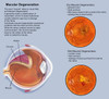 Retina with macular degeneration Poster Print by TriFocal Communications/Stocktrek Images - Item # VARPSTTRF700121H