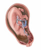 Pregnancy complication, placenta previa Poster Print by TriFocal Communications/Stocktrek Images - Item # VARPSTTRF700101H