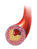 Normal artery compared to plaque and thrombus formation in artery Poster Print by TriFocal Communications/Stocktrek Images - Item # VARPSTTRF700008H