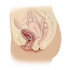 Illustration of a cystocele between a woman's bladder and vaginal wall Poster Print by TriFocal Communications/Stocktrek Images - Item # VARPSTTRF700047H