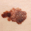 Melanoma on a patient's skin Poster Print by National Institutes of Health/Stocktrek Images - Item # VARPSTNIH700048H