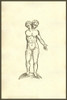 Infans biceps unico brachio,two heads on one body,siamese twins.   From the 1642 book Monstrorum Historia by Ulisse Aldrovandi .   He is considered the founder of modern Natural History. Poster Print by Ulisse Aldrovandi - Item # VARBLL0587418621