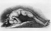 Tetanus Victim. The Contracted Body Of Soldier Suffering From Tetanus. Engraving From Painting By Charles Bell History - Item # VAREVCHISL015EC074