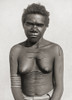 Cicatrization Scarification Custom Making Scars Body This Case Subject Is Australian Aboriginal Woman Scars Are Often Considered Improve Personal Appearance But They Can Also Represent Personal Social Religious Information After A 19th Century Photog