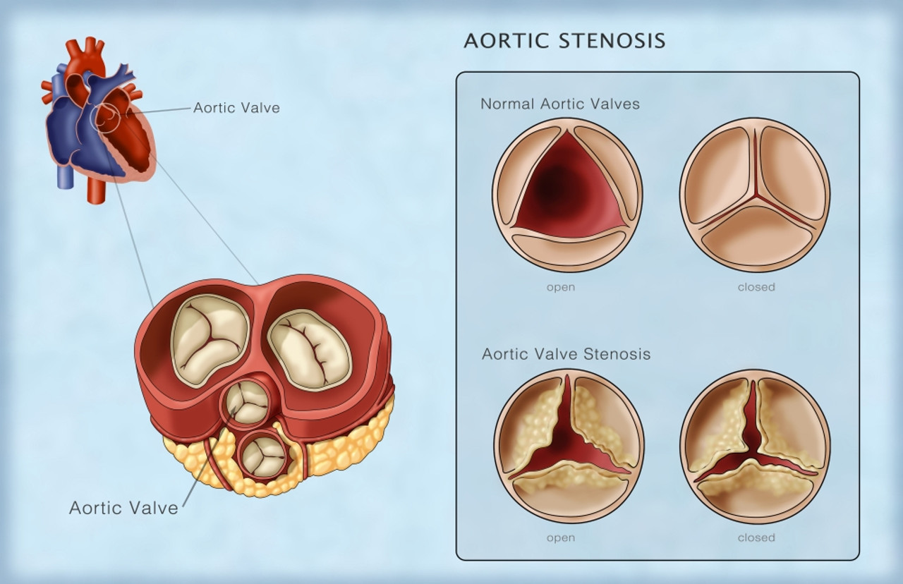 Aortic Valves, Normal & Stenosis, Illustration Poster Print by Monica  Schroeder/Science Source - Item # VARSCIJB5284