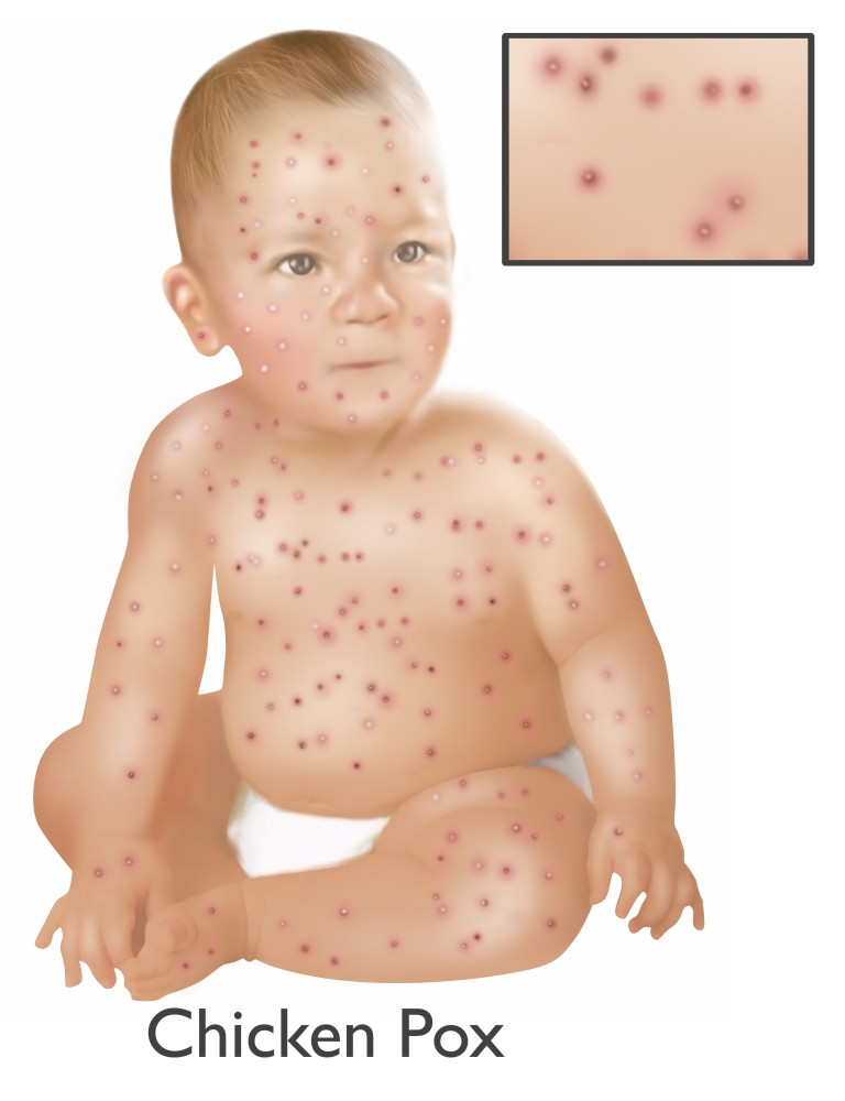 chicken pox baby images