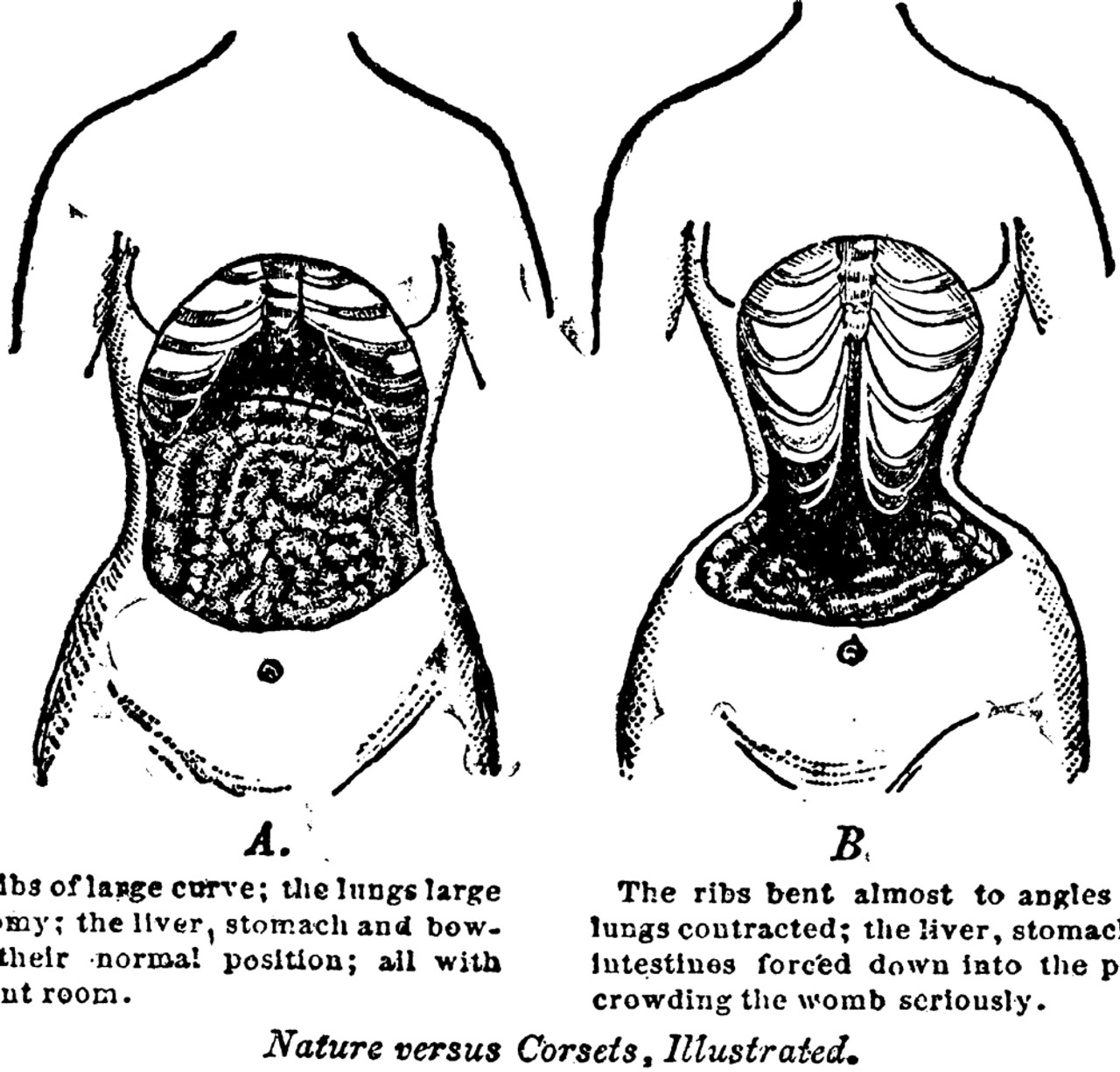 Nature Versus Corsets 1903 Ntwo Pictures Of A WomanS Torso One Showing A  Woman Without A Corset The Other Showing The Effects On The Internal Organs