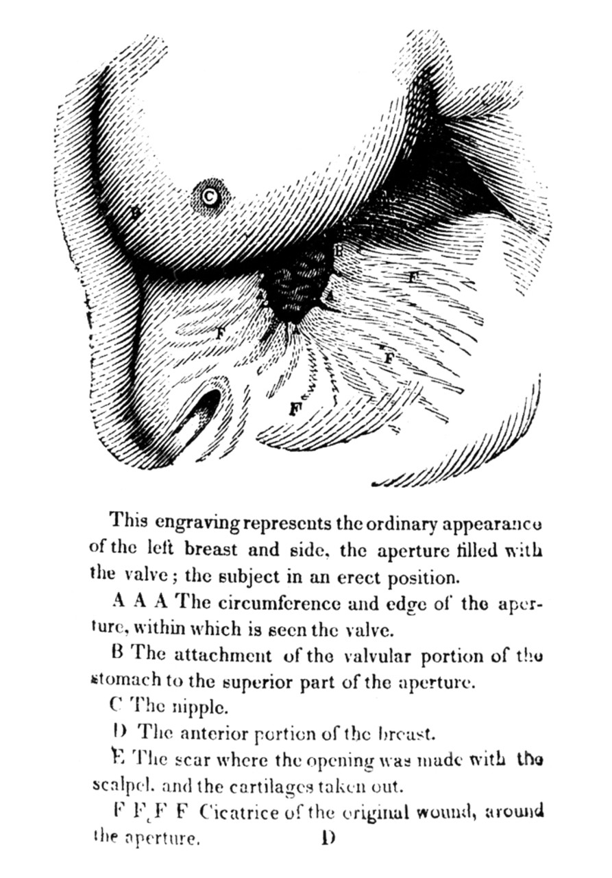 William Beaumont N 1785 1853 . American Surgeon. Page From The First Edition Of William Beaumont S Experiments And Observations On The Gastric