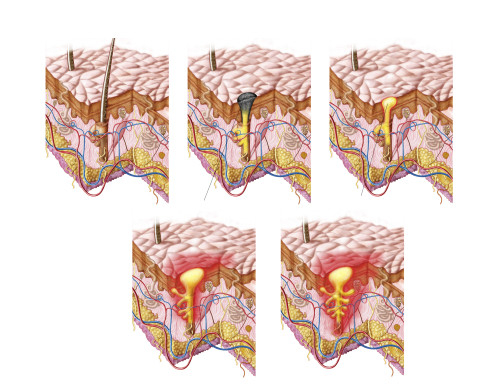 Different types of acne, non-inflammatory and inflammatory Poster Print - Item # VARPSTSTK700814H