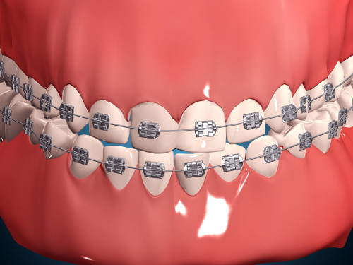 Medical illustration of human mouth showing teeth, gums and metal braces Poster Print - Item # VARPSTSTK700624H