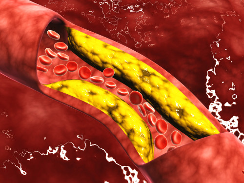 Microscopic view of fat plaque inside the artery Poster Print - Item # VARPSTSTK700479H