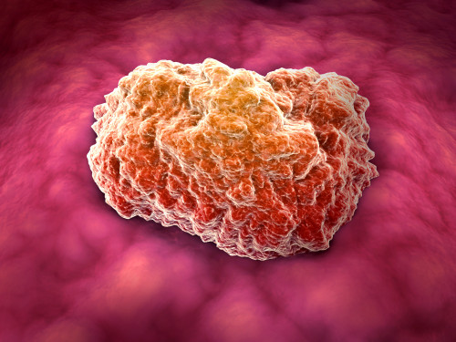 Microscopic view of tumor Poster Print