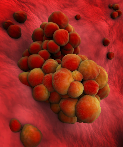 Microscopic view of tumor Poster Print - Item # VARPSTSTK700898H