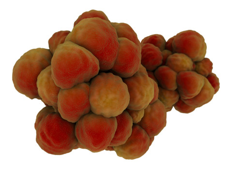 Microscopic view of tumor Poster Print