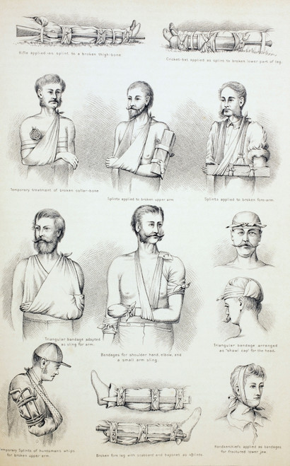 Temporary Treatment Of Fractures. From The Household Physician, Published Circa 1890. PosterPrint - Item # VARDPI1903900