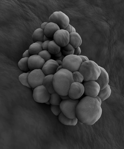 Microscopic view of tumor Poster Print - Item # VARPSTSTK700899H
