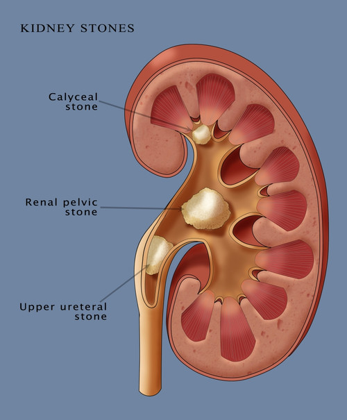 Kidney Stones, Illustration Poster Print by Monica Schroeder/Science Source - Item # VARSCIJB0667