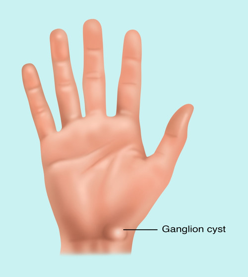 Ganglion Cyst, Illustration Poster Print by Gwen Shockey/Science Source