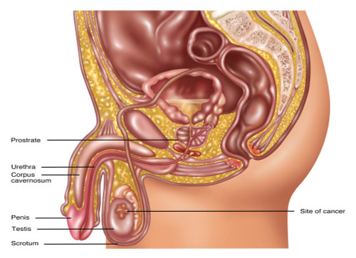 Testicular Cancer, Illustration Poster Print by Gwen Shockey/Science Source - Item # VARSCIJB6980