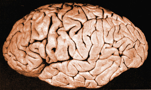 Brain of Helen Hamilton Gardener Poster Print by Science Source - Item # VARSCIJB5005