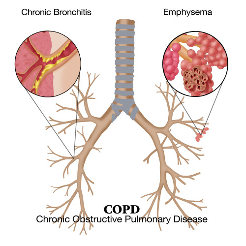 Chronic Obstructive Pulmonary Disease Poster Print by Monica Schroeder/Science Source - Item # VARSCIBV8593 Chronic Obstructive Pulmonary Disease Poster Print by Monica Schroeder/Science Source - Item # VARSCIBV8593