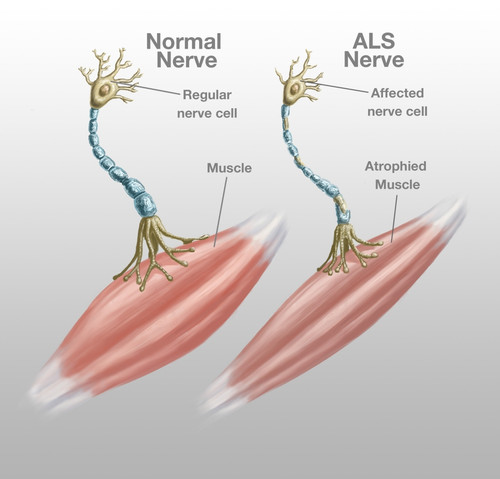 Normal Nerve and ALS Nerve Poster Print by Spencer Sutton/Science Source
