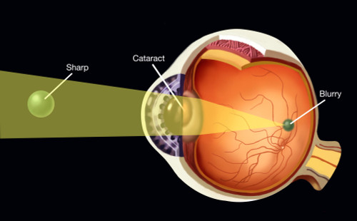 Cataract Poster Print by Spencer Sutton/Science Source - Item # VARSCIBW0801