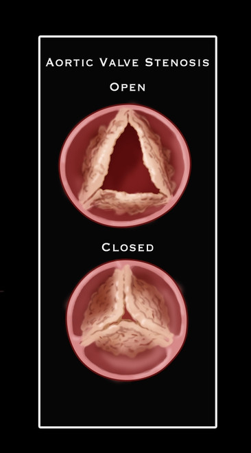 Aortic Valve Stenosis Poster Print by Monica Schroeder/Science Source - Item # VARSCIBY4110
