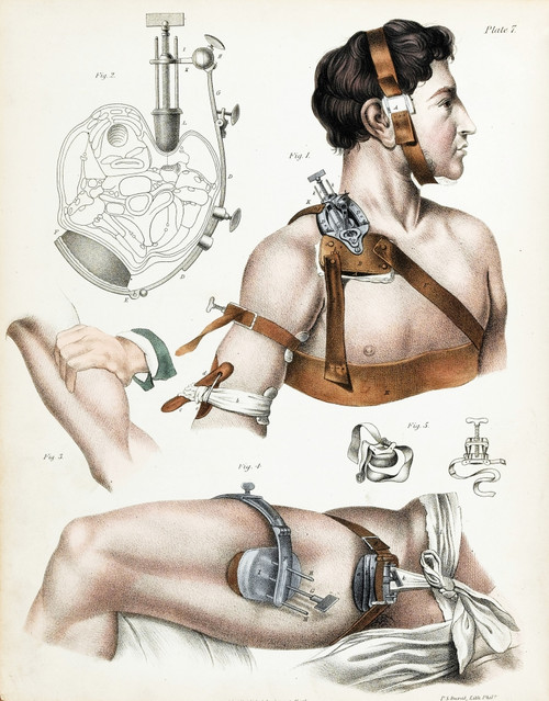 Operative Surgery, Illustration, 1846 Poster Print by Science Source