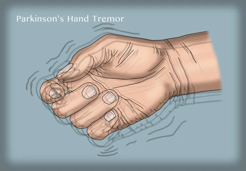 Hand Tremor, Illustration Poster Print by Monica Schroeder/Science Source