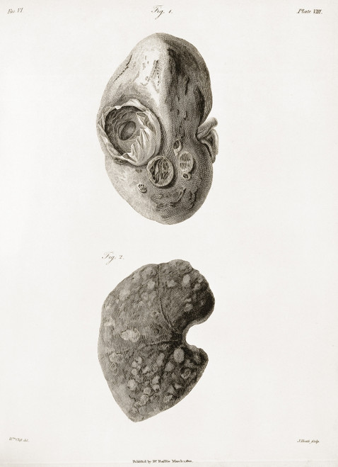 Kidney, Hydatid Disease, Illustration, c.1801 Poster Print by Science Source - Item # VARSCIJA1803