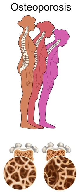 Osteoporosis Poster Print by Gwen Shockey/Science Source