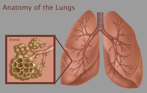 Lungs & Alveoli with Emphysema Poster Print by Gwen Shockey/Science Source - Item # VARSCIBZ3707
