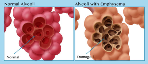 Healthy vs. Emphysematous Alveoli Poster Print by Monica Schroeder/Science Source - Item # VARSCIBZ3955