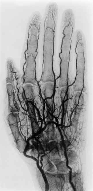 Hand Arteriogram, Early X-ray Poster Print by Science Source - Item # VARSCI9M6791