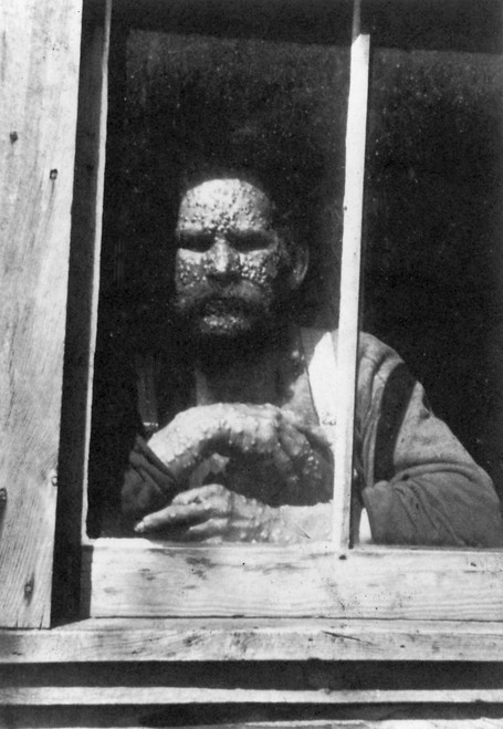Smallpox Quarantine, 1890 Poster Print by Science Source - Item # VARSCIBN9556