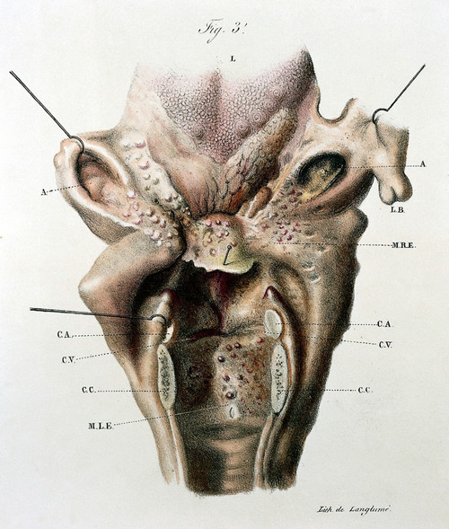 Larynx, Pathology, Illustration, 19th Century Poster Print by Science Source - Item # VARSCIJA1806