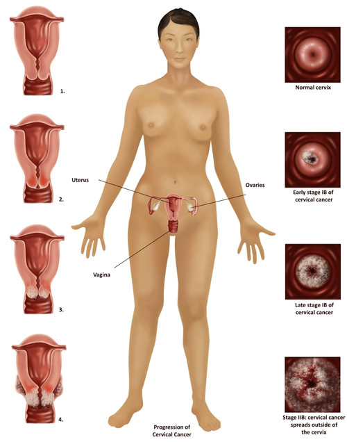 Cervical Cancer Poster Print by Gwen Shockey/Science Source - Item # VARSCIBW1345