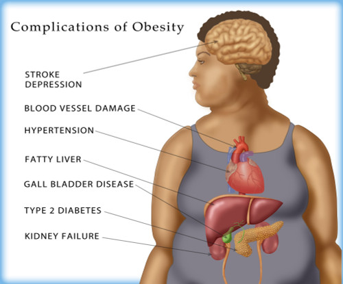 Complications of Obesity, Illustration Poster Print by Monica Schroeder/Science Source - Item # VARSCIJA7861