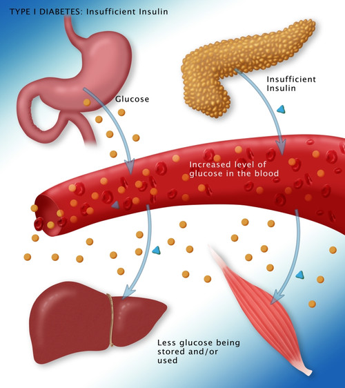 Type I Diabetes Poster Print by Monica Schroeder/Science Source - Item # VARSCIBY4055