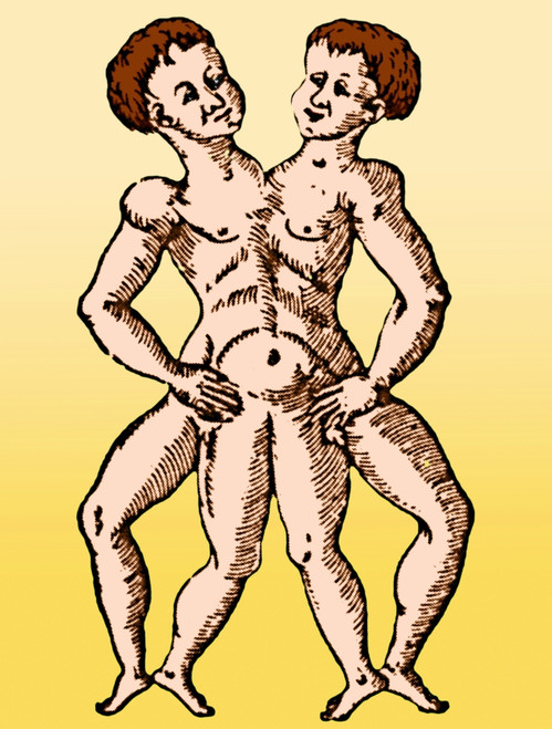 Conjoined Twins, 16th Century Poster Print by Science Source - Item # VARSCIBZ6474