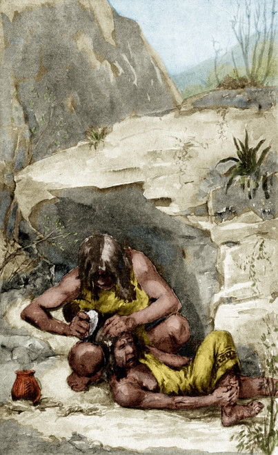 Prehistoric Surgical Operation, Cautery Poster Print by Science Source