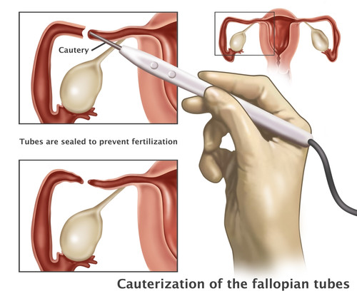 Cauterization of the Fallopian Tubes Poster Print by Gwen Shockey/Science Source - Item # VARSCIJA0524