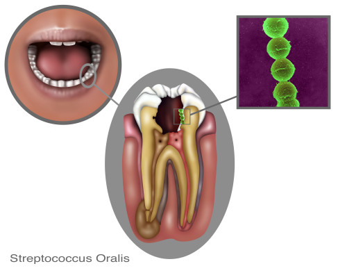 Oral Infection of Streptococcus Oralis Poster Print by Gwen Shockey/Science Source - Item # VARSCIJB3221