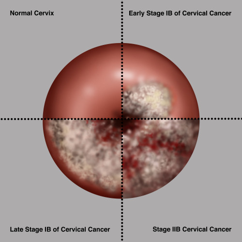 Cervical Cancer Progression, Illustration Poster Print by Gwen Shockey/Science Source - Item # VARSCIJB3298