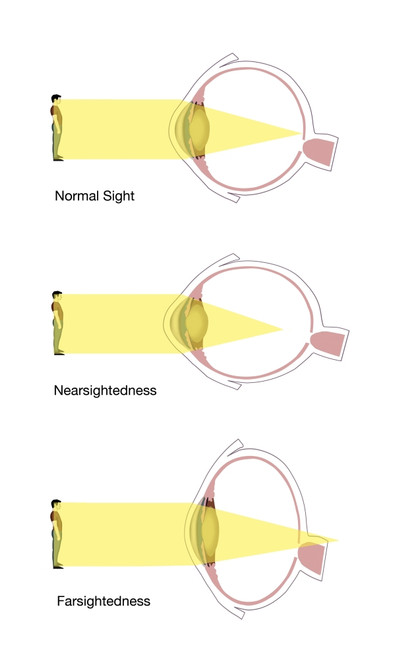 Normal, Nearsighted, and Farsighted Vision Poster Print by Spencer Sutton/Science Source - Item # VARSCIBU5158