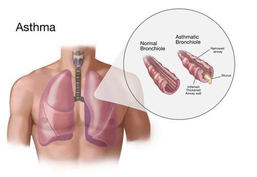 Asthma and Bronchioles Poster Print by Spencer Sutton/Science Source - Item # VARSCIBZ4300