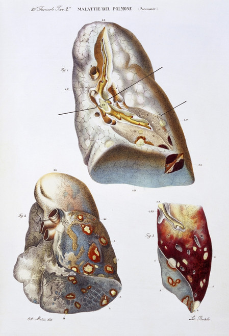 Lung, Diseases, Illustration, 1843 Poster Print by Science Source - Item # VARSCIJA1818