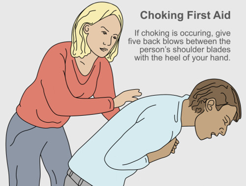 Choking First Aid Poster Print by Gwen Shockey/Science Source - Item # VARSCIBY1896