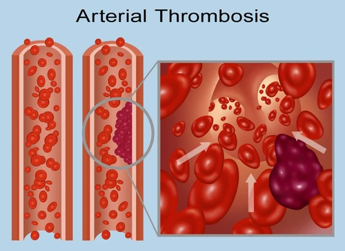 Arterial Thrombus and Embolus Poster Print by Gwen Shockey/Science Source